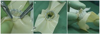 Transcatheter mitral valve replacement in native mitral valve with severe mitral annular calcification: Skirting the Sapien 3 to reduce the risk of paravalvular leaks